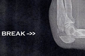 x-ray image of Arlene's broken elbow