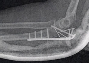 x-ray image of Arlene's elbow with plate and screws